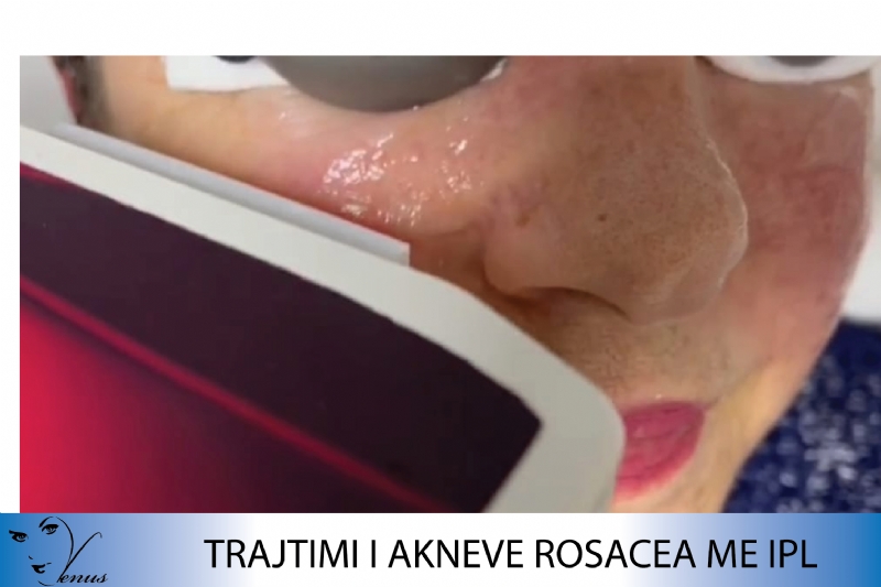 Klinika Venus, Mesoterapi per syte, Mesoterapi per fytyren, Mesoterapi p...
